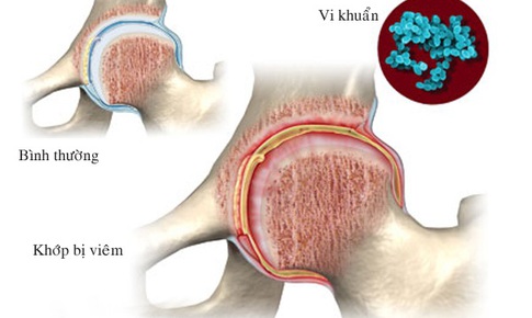 Chớ xem thường vi&#234;m khớp nhiễm khuẩn