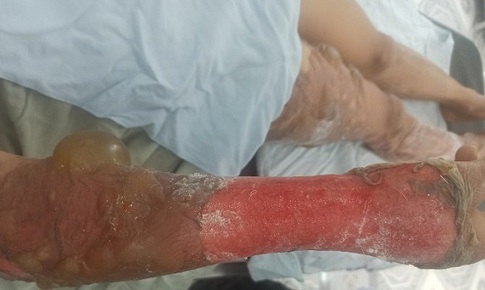 Cấp cứu kịp thời bệnh nhân bỏng nước sôi