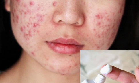 Lạm dụng thuốc bôi trị mụn, mụn càng nhiều hơn