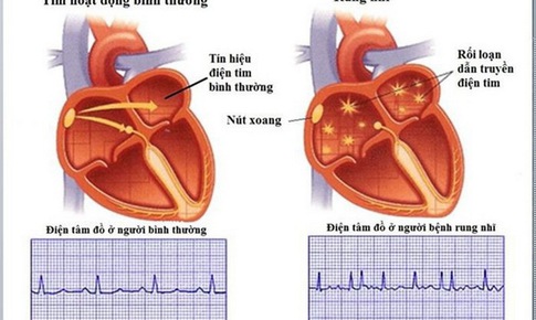 Nhiều đột ph&#225; trong ứng dụng điều trị c&#225;c bệnh tim mạch