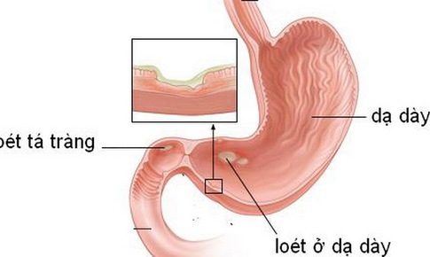 D&#249;ng thuốc giảm đau, coi chừng lo&#233;t dạ d&#224;y - t&#225; tr&#224;ng