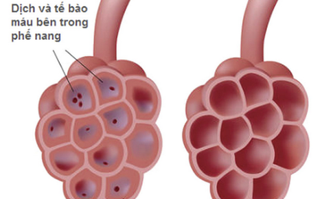 Bài thuốc hỗ trợ trị nhiễm trùng ở phổi