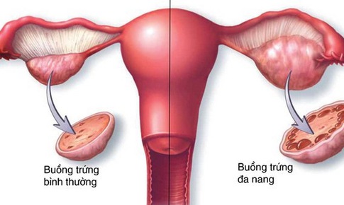 Bệnh l&#253; ở bu&#244;̀ng trứng g&#226;y kh&#243; thụ thai