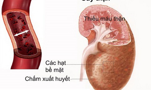 D&#226;́u hi&#234;̣u nh&#226;̣n bi&#234;́t chức năng th&#226;̣n suy giảm