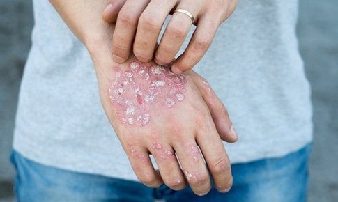 Những điều cần làm khi mắc chàm
