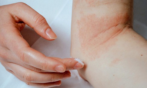 C&#225;ch giảm ngứa khi bị eczema