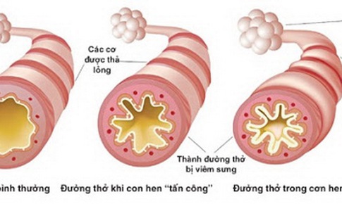 Hướng điều trị mới c&#225;c bệnh vi&#234;m đường h&#244; hấp mạn t&#237;nh