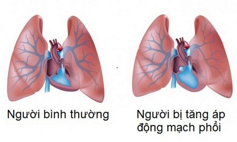 Tăng &#225;p động mạch phổi v&#224; những lưu &#253;