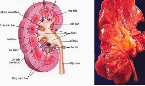 Dấu hiệu vi&#234;m cầu thận cấp