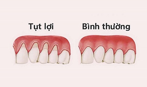 Hậu quả đ&#225;ng ngại khi bị tụt lợi