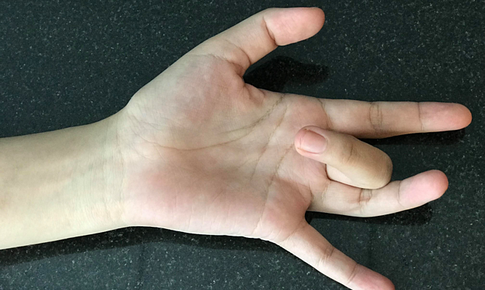 Hiểu đúng về bệnh ngón tay lò xo