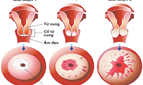 Dấu hiệu cảnh b&#225;o ung thư cổ tử cung