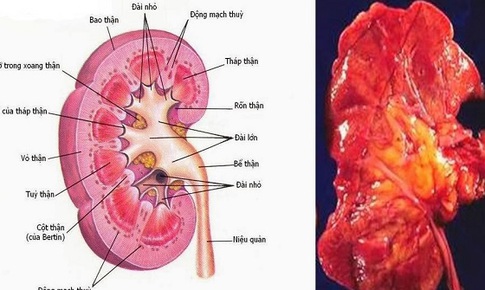 B&#224;i thuốc hỗ trợ trị vi&#234;m cầu thận cấp