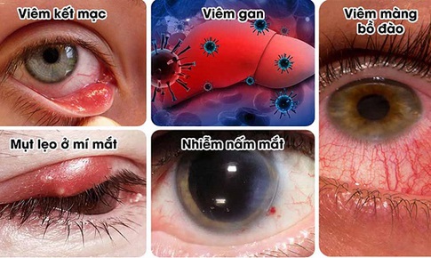 Nhận biết sớm nhiễm tr&#249;ng mắt, ph&#242;ng biến chứng