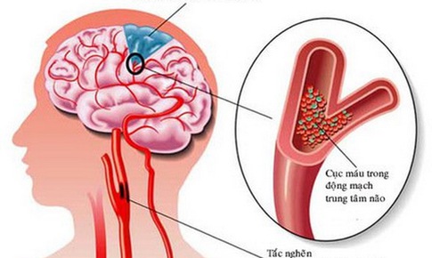 Đột quỵ v&#236; tự dừng thuốc chống đ&#244;ng m&#225;u