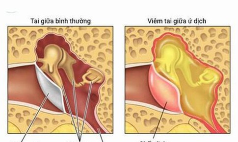 Tự điều trị vi&#234;m tai giữa, biến chứng kh&#243; lường