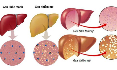 Cần l&#224;m g&#236; khi bị gan nhiễm mỡ?