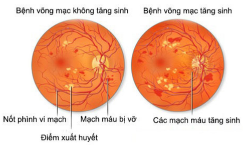 Ph&#242;ng ngừa bệnh v&#245;ng mạc đ&#225;i th&#225;o đường