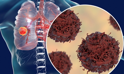 75% ung thư phổi kh&#244;ng sớm ph&#225;t hiện được, v&#236; sao?