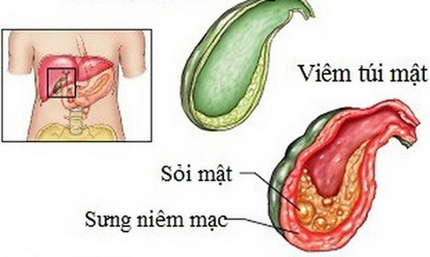 Thời điểm cần phẫu thuật sỏi t&#250;i mật