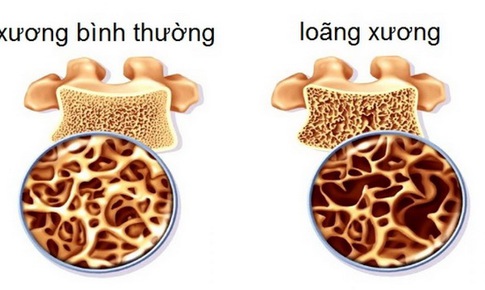 Thuốc lo&#227;ng xương phải sử dụng l&#226;u d&#224;i