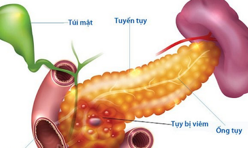 Biến chứng dễ gặp của vi&#234;m tụy mạn t&#237;nh