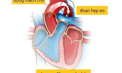 Hẹp eo động mạch chủ: Ti&#234;n lượng tốt nếu chẩn đo&#225;n sớm