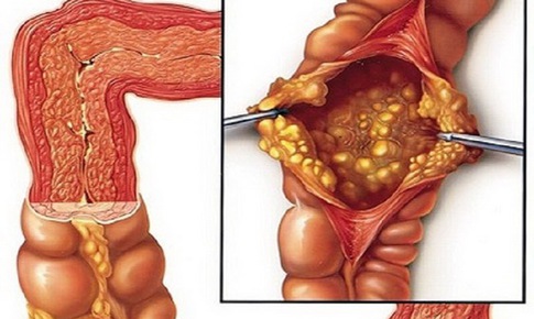 Một số bệnh l&#253; ở ruột non thường gặp