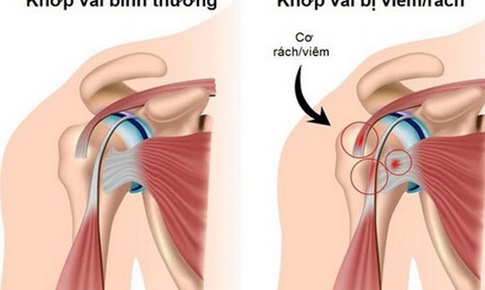 Ứng ph&#243; với vi&#234;m quanh khớp vai