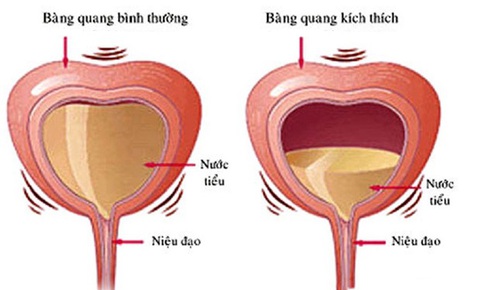 Thuốc g&#236; khắc phục hội chứng b&#224;ng quang tăng hoạt?