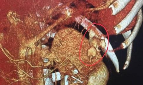 Bị ng&#227; tưởng kh&#244;ng sao, kh&#244;ng ngờ vỡ thận su&#253;t tử vong