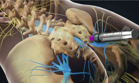 Hiệu quả của ti&#234;m corticosteroid ngo&#224;i m&#224;ng cứng trị đau d&#226;y thần kinh tọa c&#242;n hạn chế