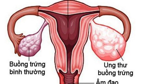 Liệu ph&#225;p ti&#234;u chuẩn mới trong điều trị ung thư buồng trứng t&#225;i ph&#225;t