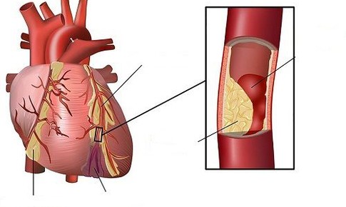 Ph&#225;t hiện cơ chế tạo  mỡ xấu trong cơ thể