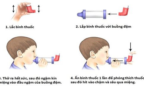 C&#225;ch sử dụng b&#236;nh h&#237;t định liều với buồng đệm trong bệnh hen phế quản trẻ em