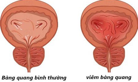 Có thể rút ngắn phác đồ kháng sinh trị viêm bàng quang cấp ở phụ nữ