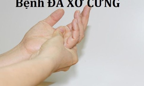 Rituximab liều thấp hiệu quả v&#224; an to&#224;n hơn trong bệnh đa xơ cứng