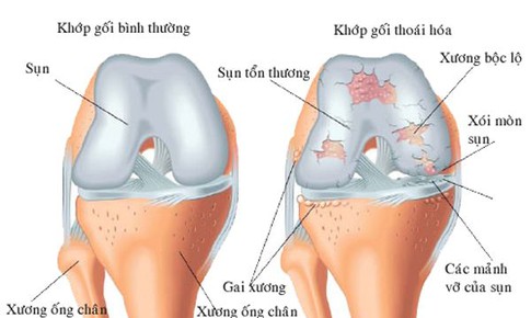 Có thể chẩn đoán thoái hóa khớp trước khi xuất hiện các triệu chứng?