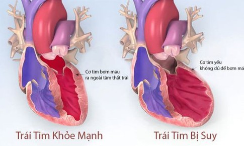 Thuốc dapagliflozin có thể làm giảm các biến cố suy tim