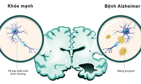 Nghi&#234;n cứu vắc-xin chống lại bệnh Alzheimer