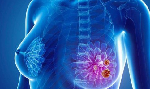 Có thể phát hiện được dấu hiệu sớm của ung thư vú?