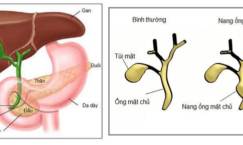 Cần ph&#225;t hiện sớm u nang ống mật chủ