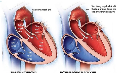 Hở van động mạch chủ&#160;c&#243; cần mổ ?