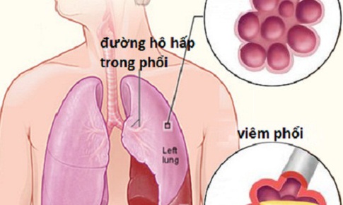 6 bệnh vi&#234;m phổi - phế quản thường gặp