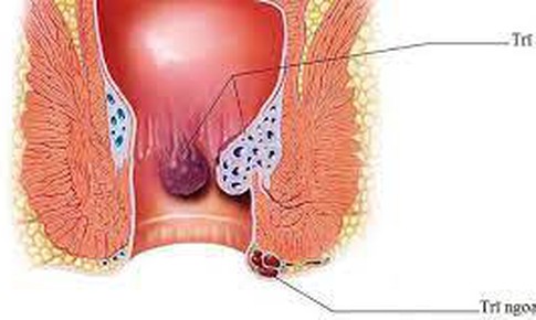 Biến chứng nguy hiểm của bệnh trĩ