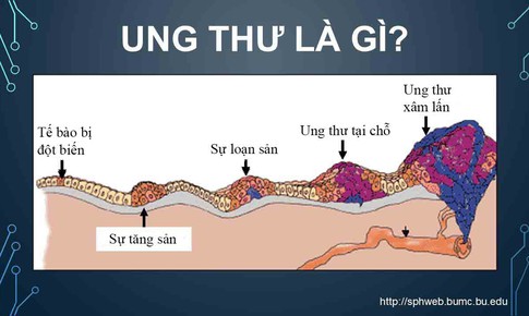 Từ th&#244;ng tin diễn vi&#234;n Mai Phương bị K phổi, h&#227;y t&#236;m hiểu về ung thư qua g&#243;c nh&#236;n b&#225;c sĩ chuy&#234;n khoa