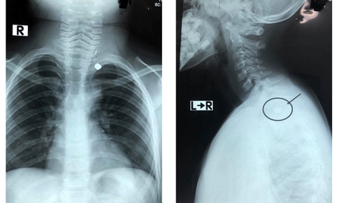 Kinh hoàng bé trai 6 tuổi bị đạn súng bắn xuyên từ cổ đến ngực