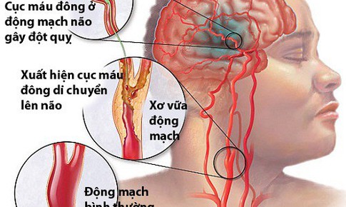 B&#225;c sĩ lưu &#253; g&#236; để ph&#242;ng đột quỵ - tai biến mạch m&#225;u n&#227;o khi m&#249;a lạnh?