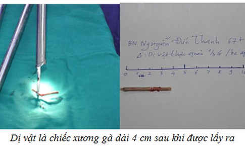 Người đ&#224;n &#244;ng nhập viện cấp cứu v&#236; một chiếc xương g&#224;