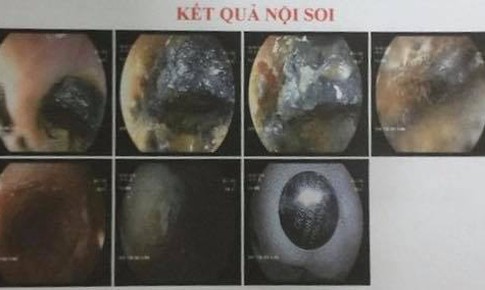 Gắp quả pin đồng hồ đã phôi màu trong thực quản bé 2 tuổi